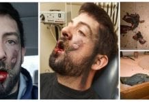 E-cig explodes in an Idaho man’s face, loses 7 teeth and suffers second degree burns